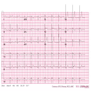 Brugada-type-2