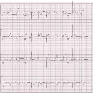 Syncope